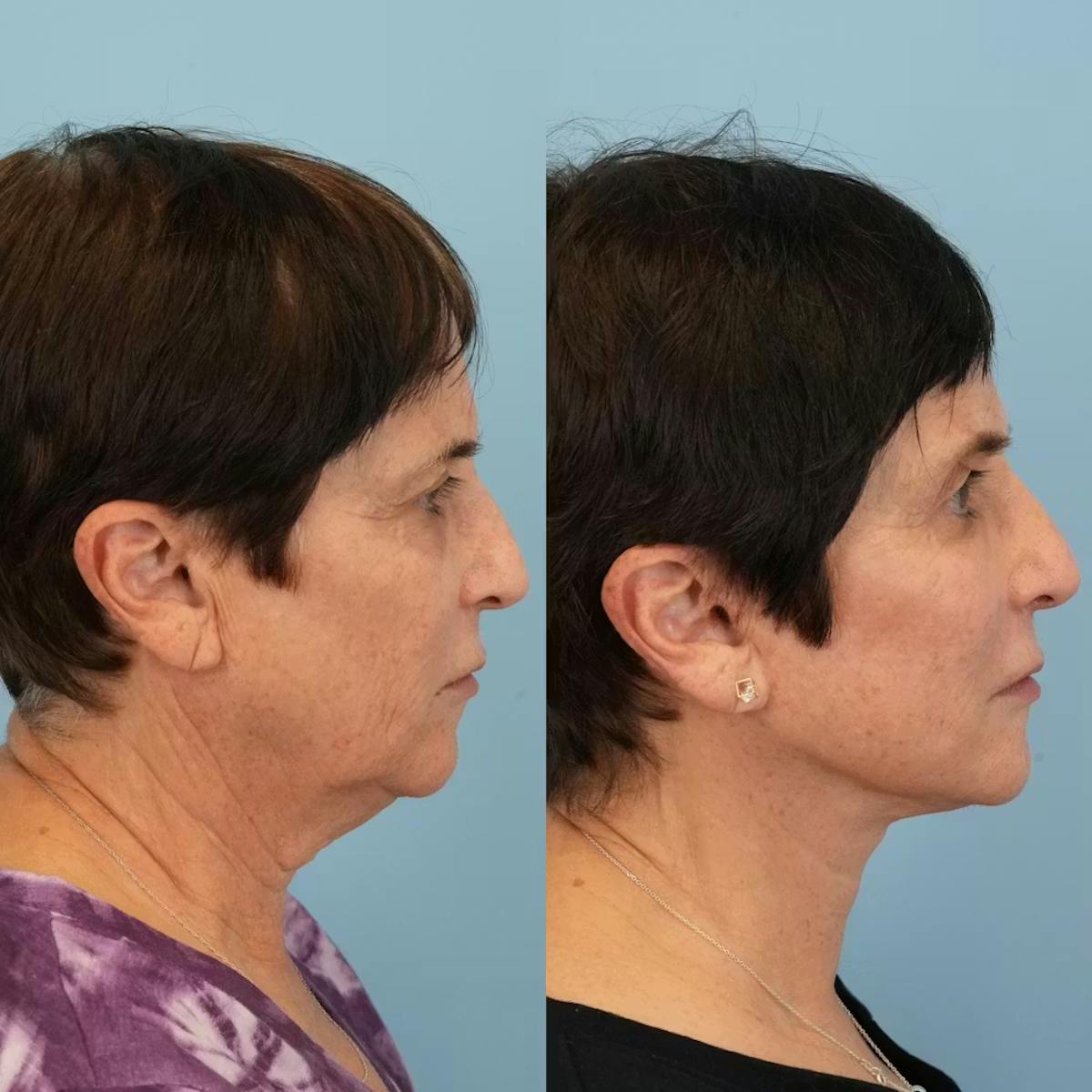 Upper Eyelids Before & After Gallery - Patient 178062 - Image 4