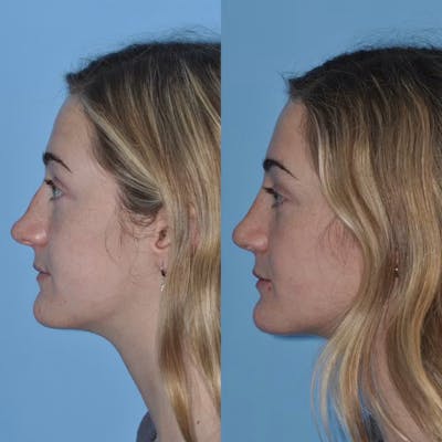 Rhinoplasty Before & After Gallery - Patient 421308 - Image 1