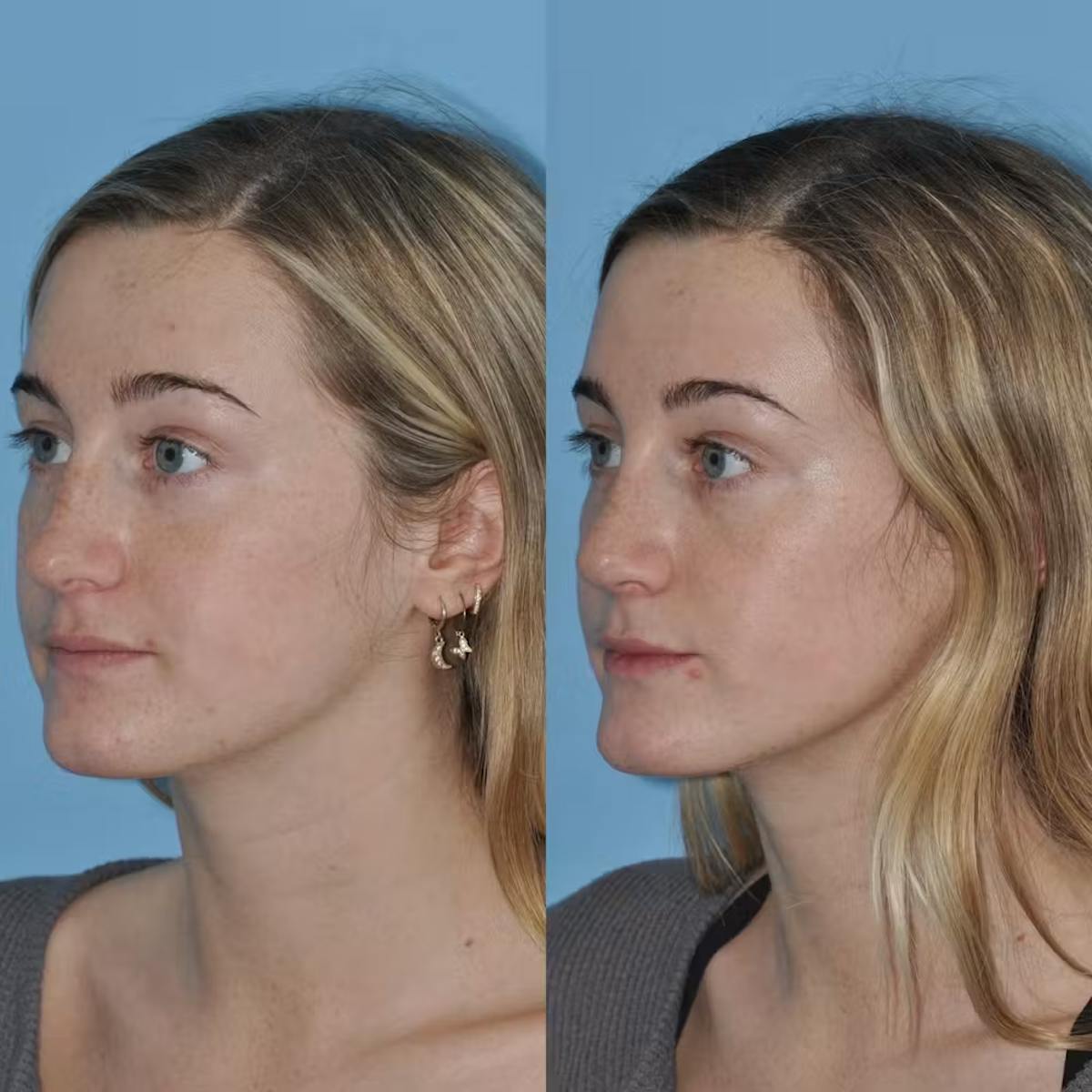 Rhinoplasty Before & After Gallery - Patient 421308 - Image 5