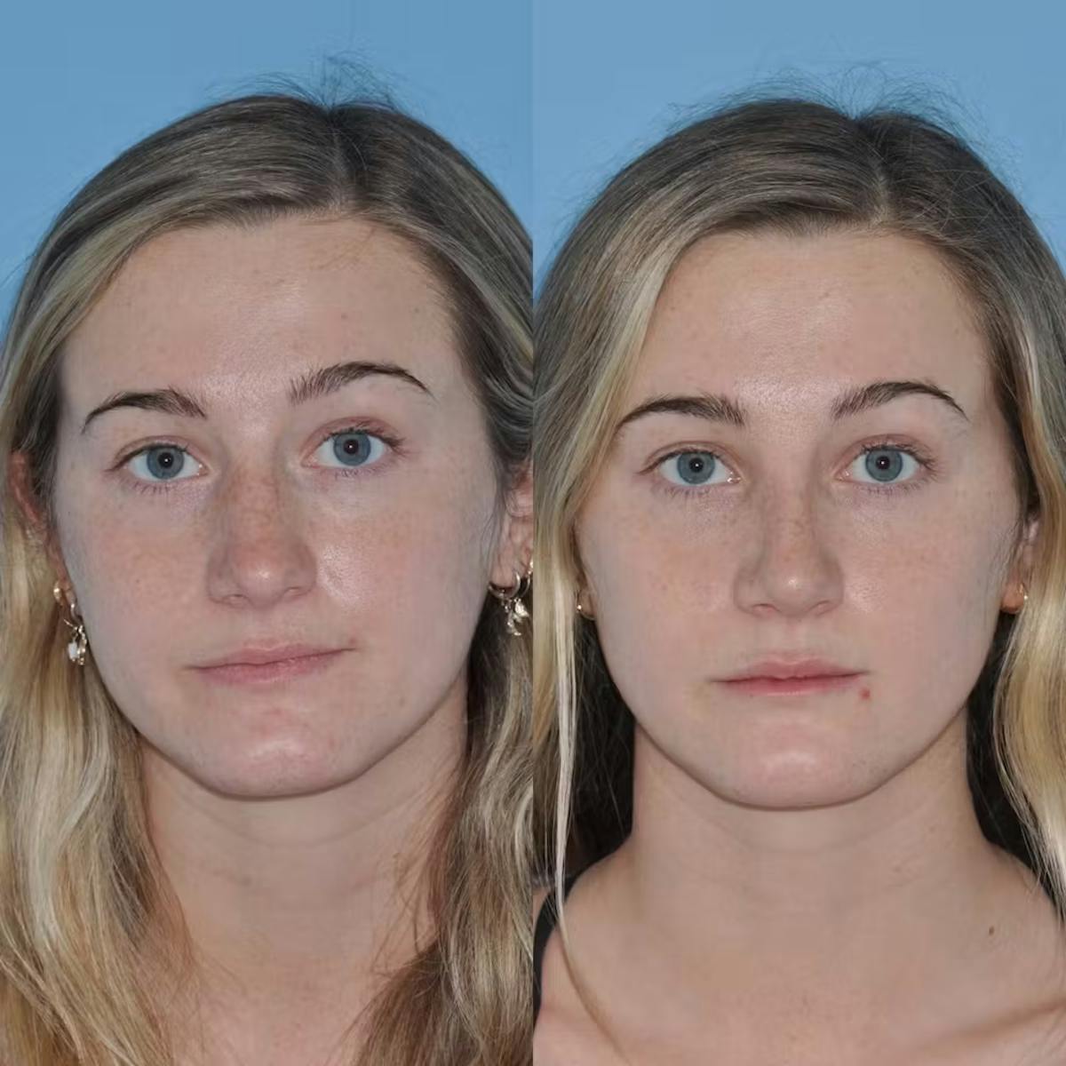 Rhinoplasty Before & After Gallery - Patient 421308 - Image 4