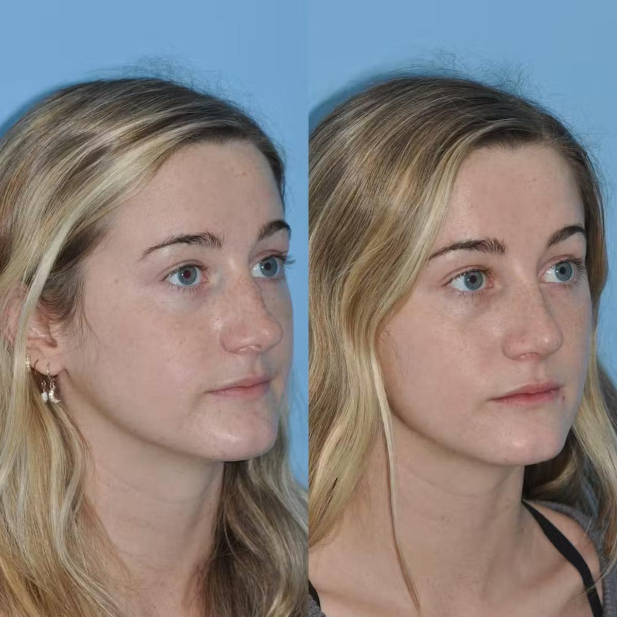 Rhinoplasty Before & After Gallery - Patient 421308 - Image 3