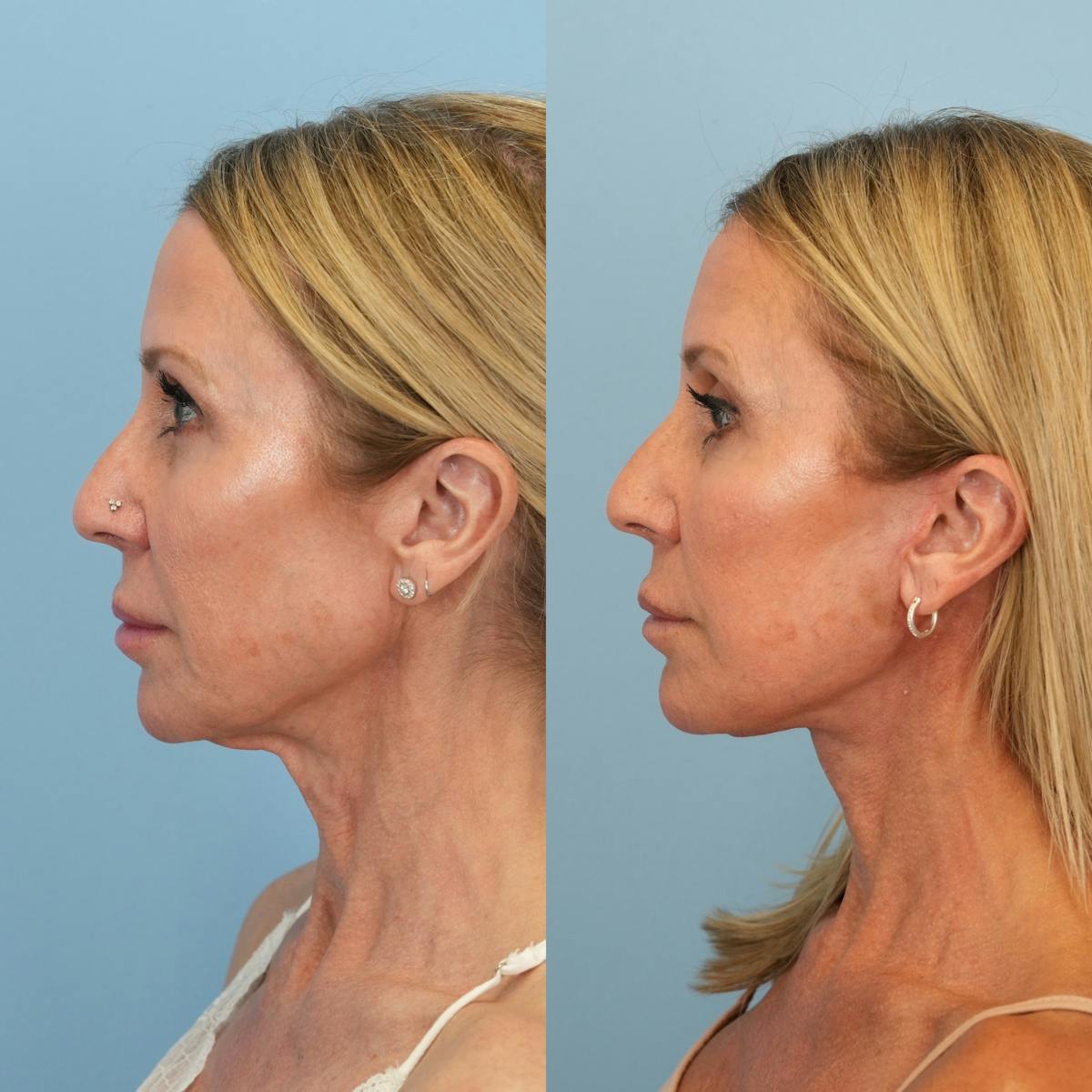 Facelift Before & After Gallery - Patient 639712 - Image 5