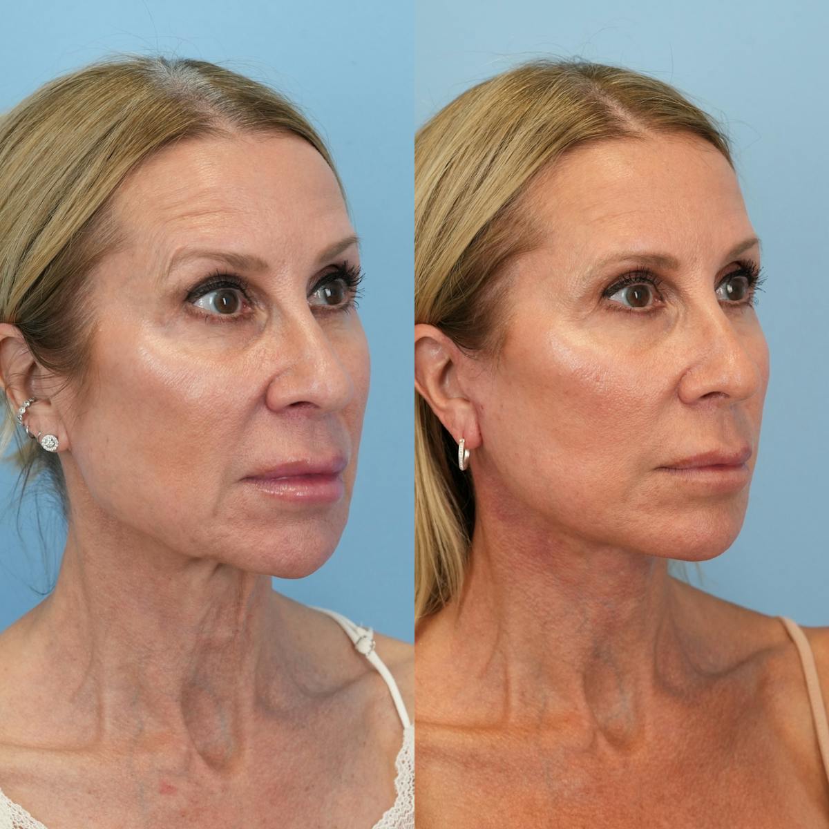 Facelift Before & After Gallery - Patient 639712 - Image 2