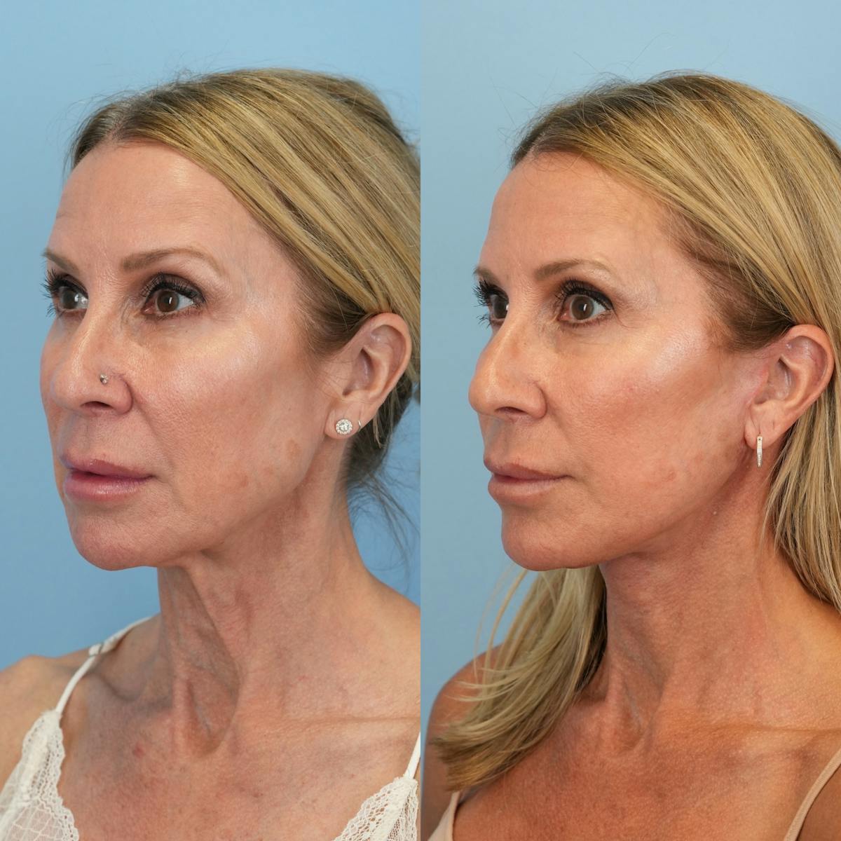 Facelift Before & After Gallery - Patient 639712 - Image 4
