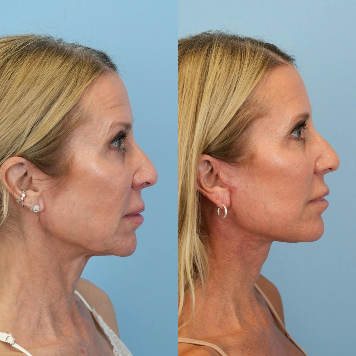 Facelift Before & After Gallery - Patient 639712 - Image 3