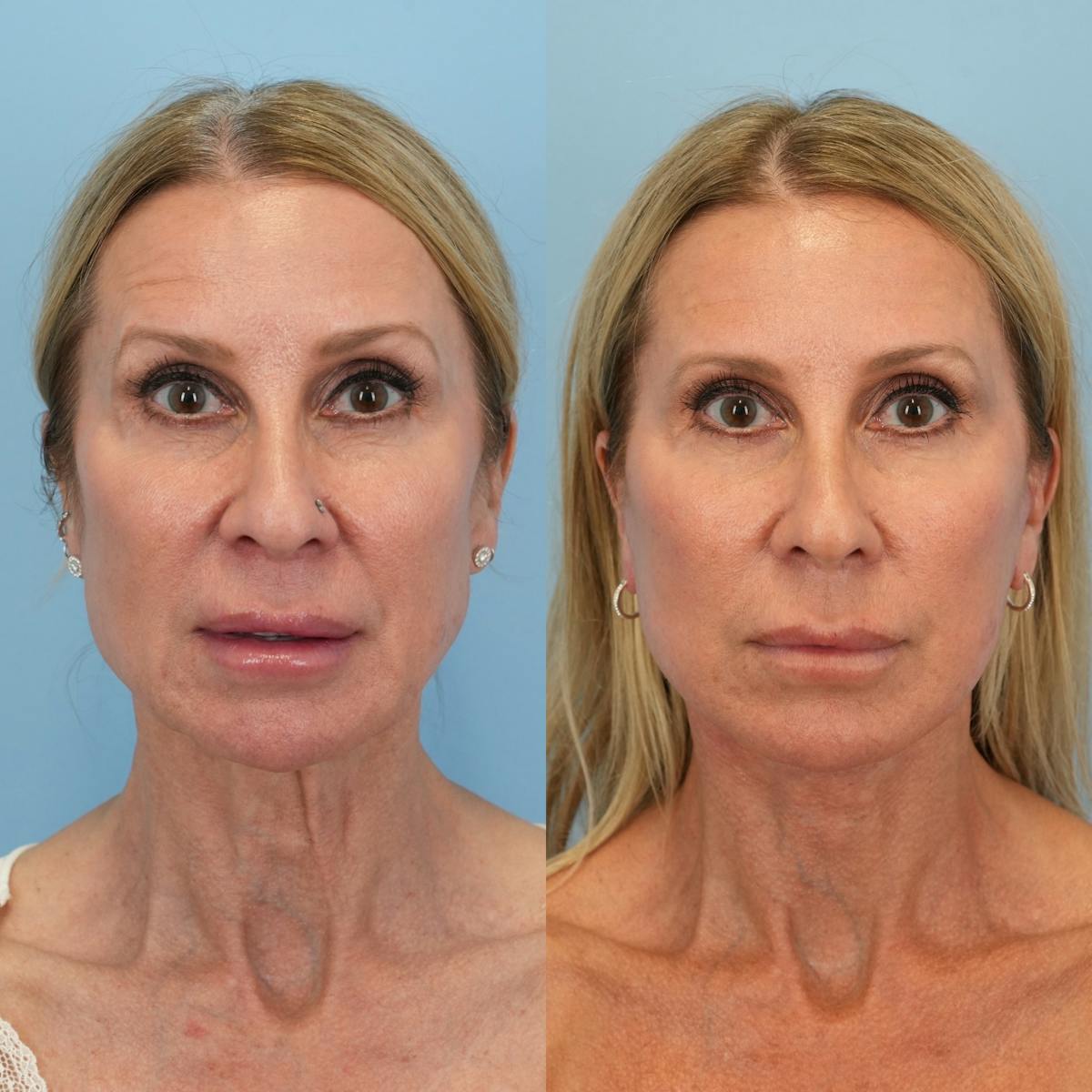 Facelift Before & After Gallery - Patient 639712 - Image 1