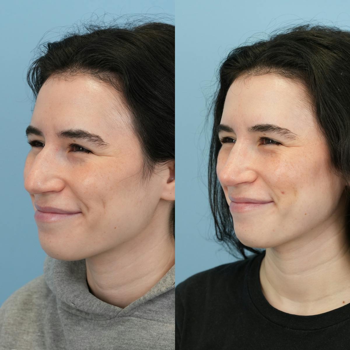 Rhinoplasty Before & After Gallery - Patient 396567 - Image 7
