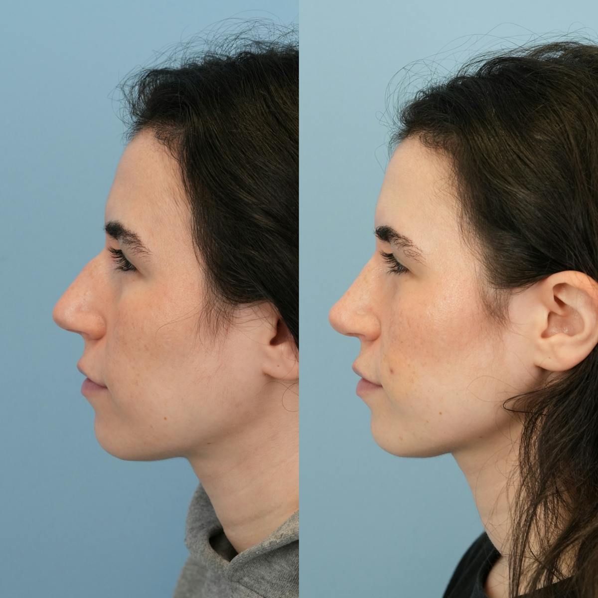 Rhinoplasty Before & After Gallery - Patient 396567 - Image 9