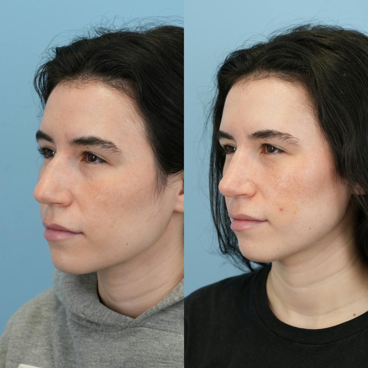 Rhinoplasty Before & After Gallery - Patient 396567 - Image 6