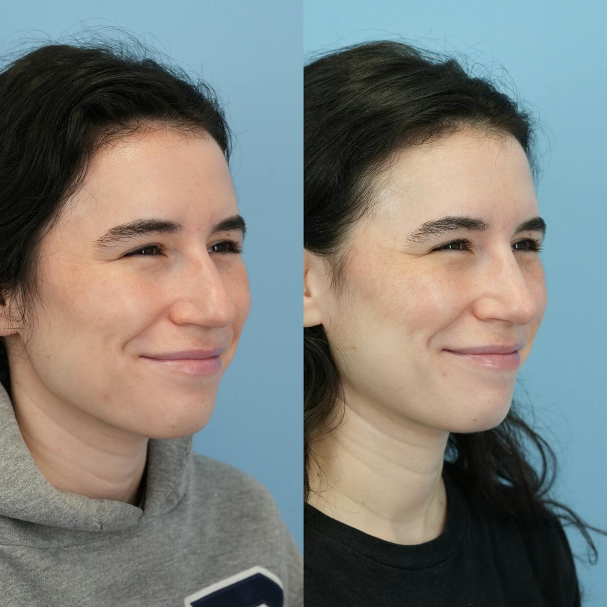 Rhinoplasty Before & After Gallery - Patient 396567 - Image 4