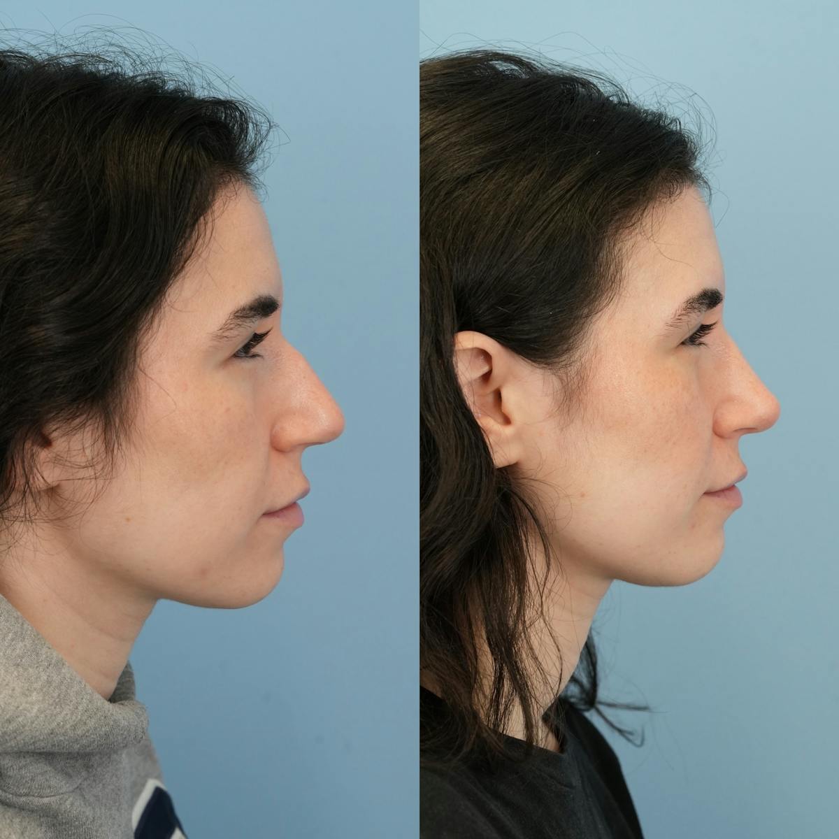 Rhinoplasty Before & After Gallery - Patient 396567 - Image 1