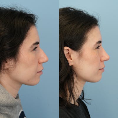 Rhinoplasty Before & After Gallery - Patient 396567 - Image 1