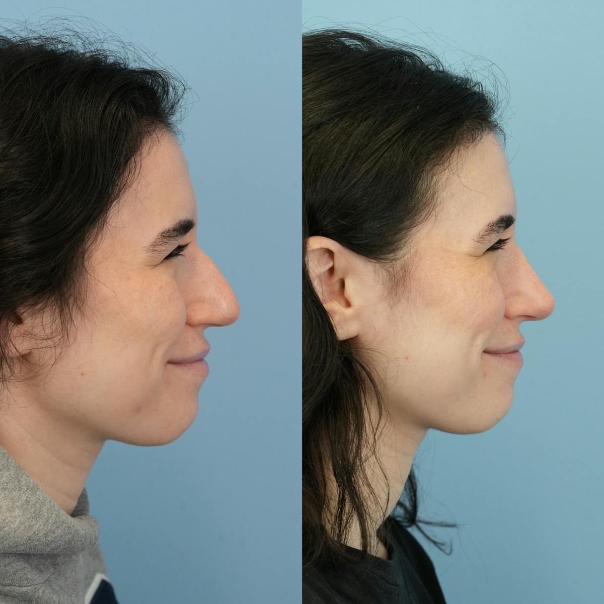 Rhinoplasty Before & After Gallery - Patient 396567 - Image 2