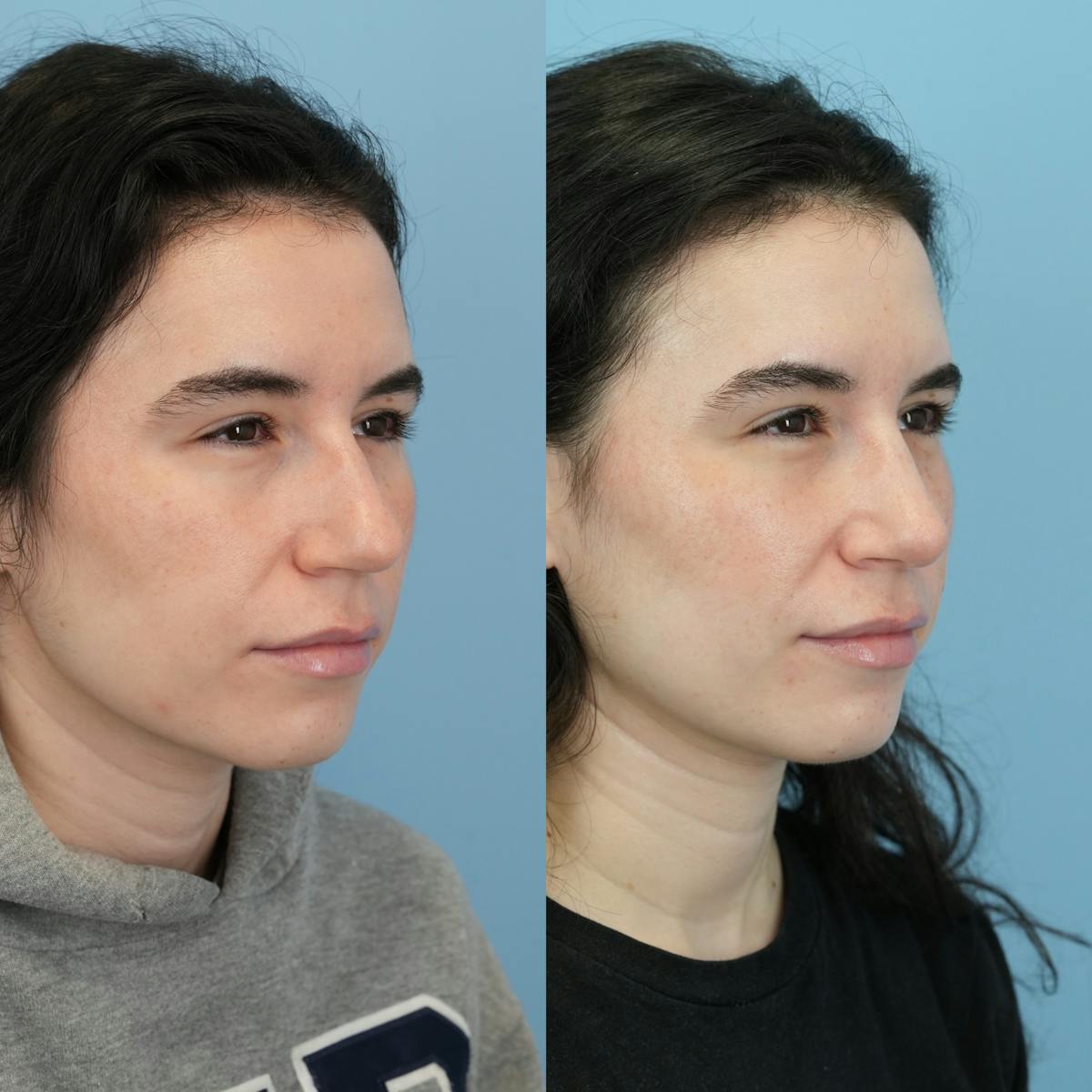 Rhinoplasty Before & After Gallery - Patient 396567 - Image 3