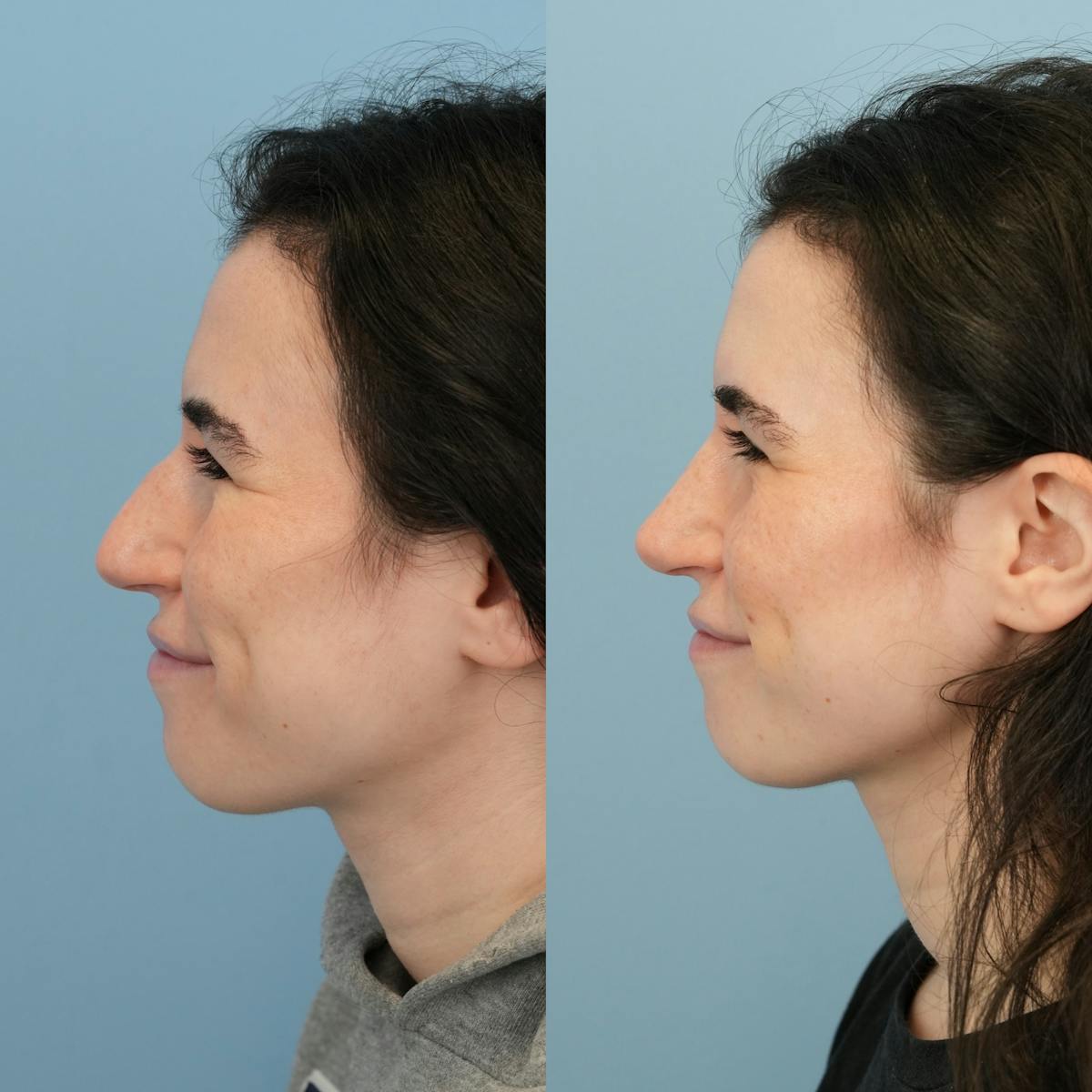 Rhinoplasty Before & After Gallery - Patient 396567 - Image 8