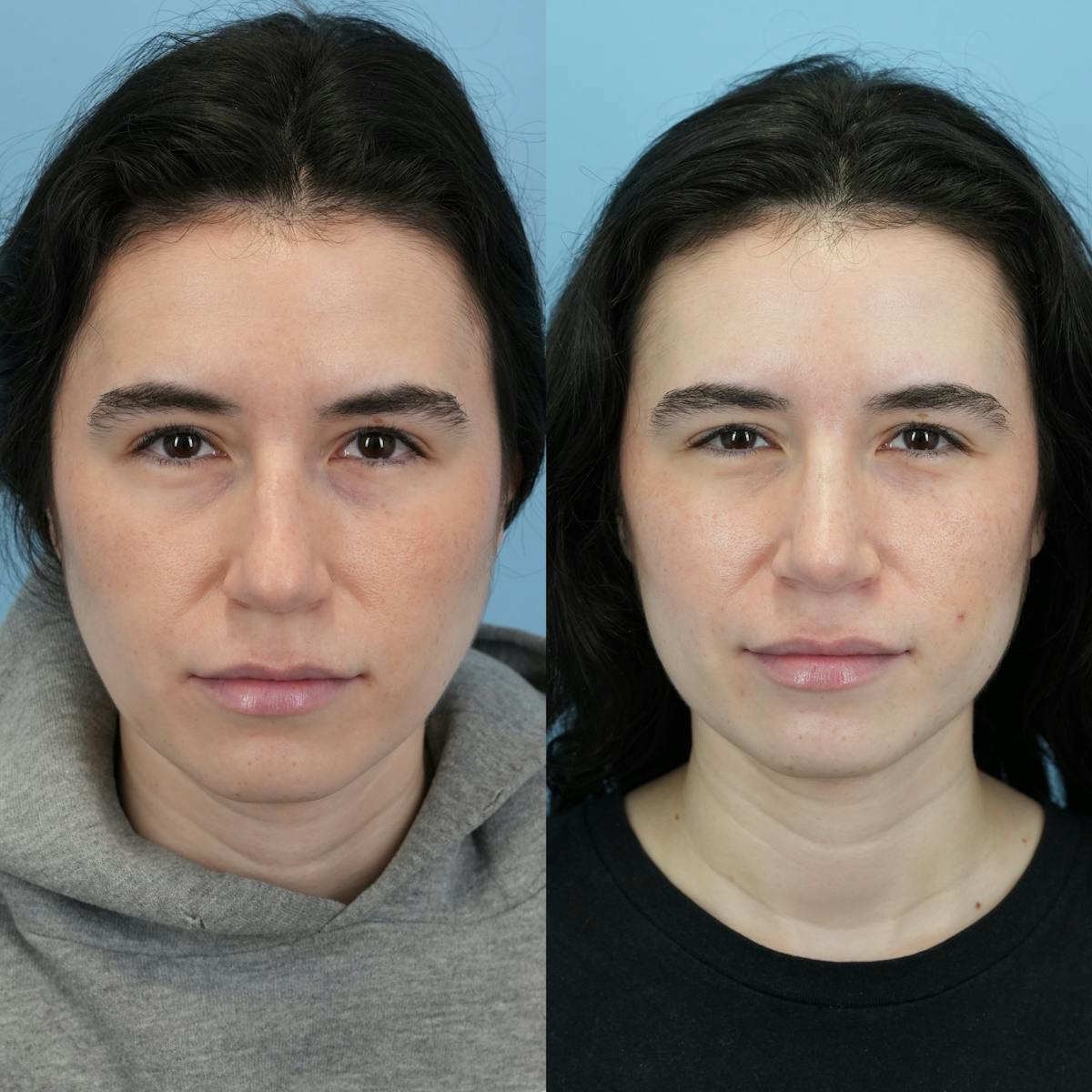 Rhinoplasty Before & After Gallery - Patient 396567 - Image 5