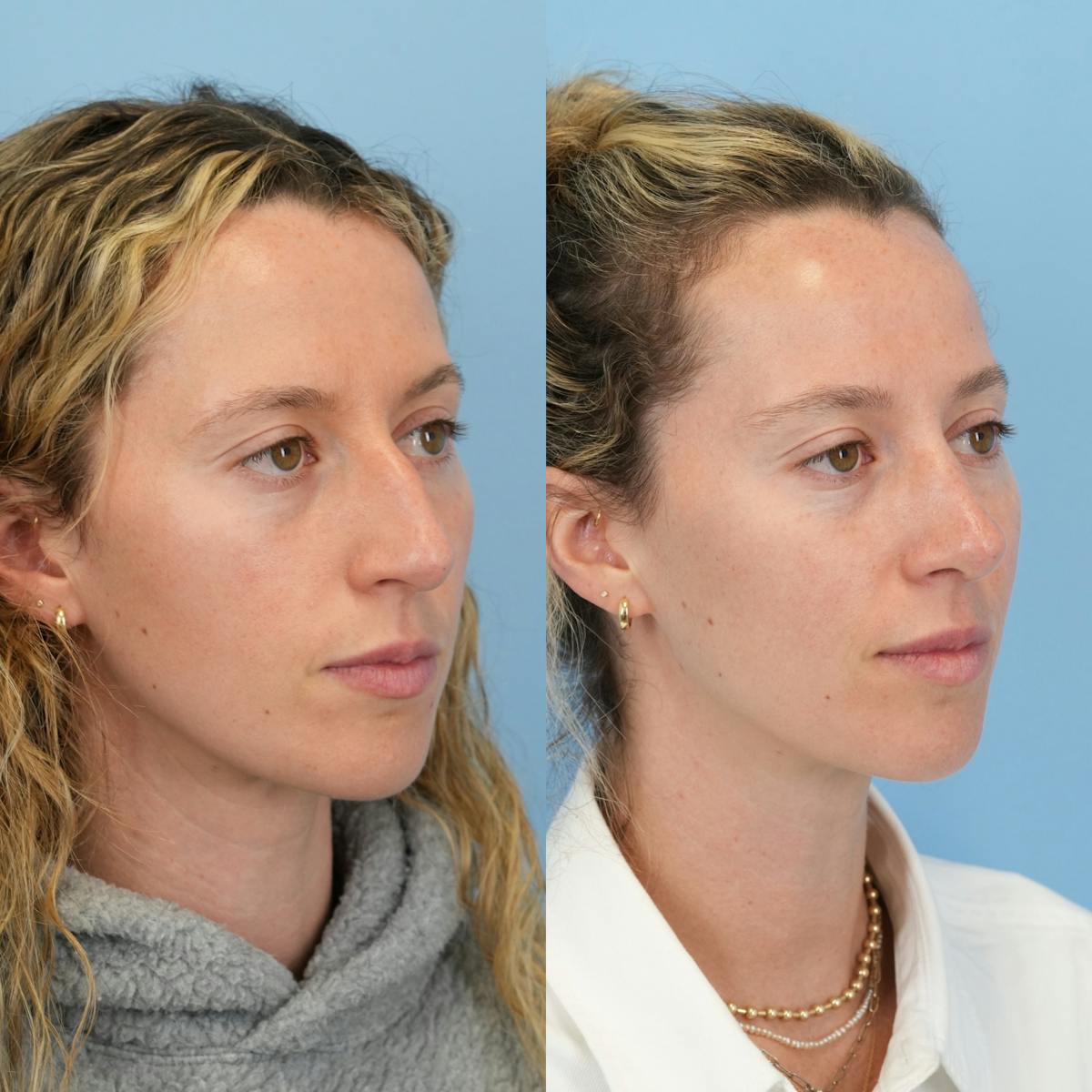 Rhinoplasty Before & After Gallery - Patient 417134 - Image 3