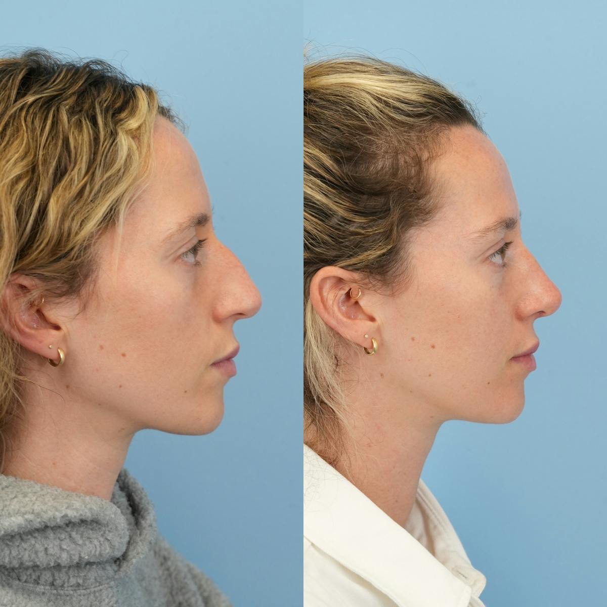 Rhinoplasty Before & After Gallery - Patient 417134 - Image 1