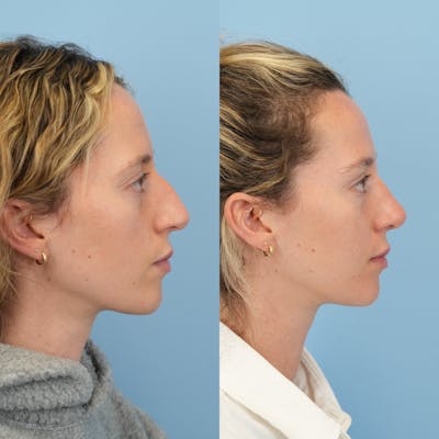 Rhinoplasty Before & After Gallery - Patient 417134 - Image 1