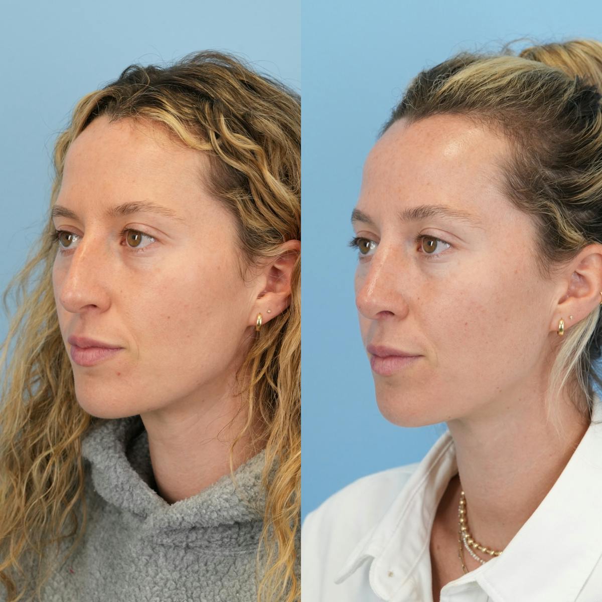 Rhinoplasty Before & After Gallery - Patient 417134 - Image 7