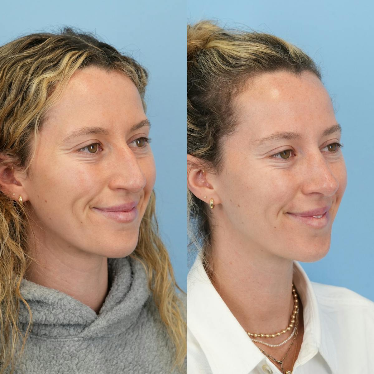 Rhinoplasty Before & After Gallery - Patient 417134 - Image 4