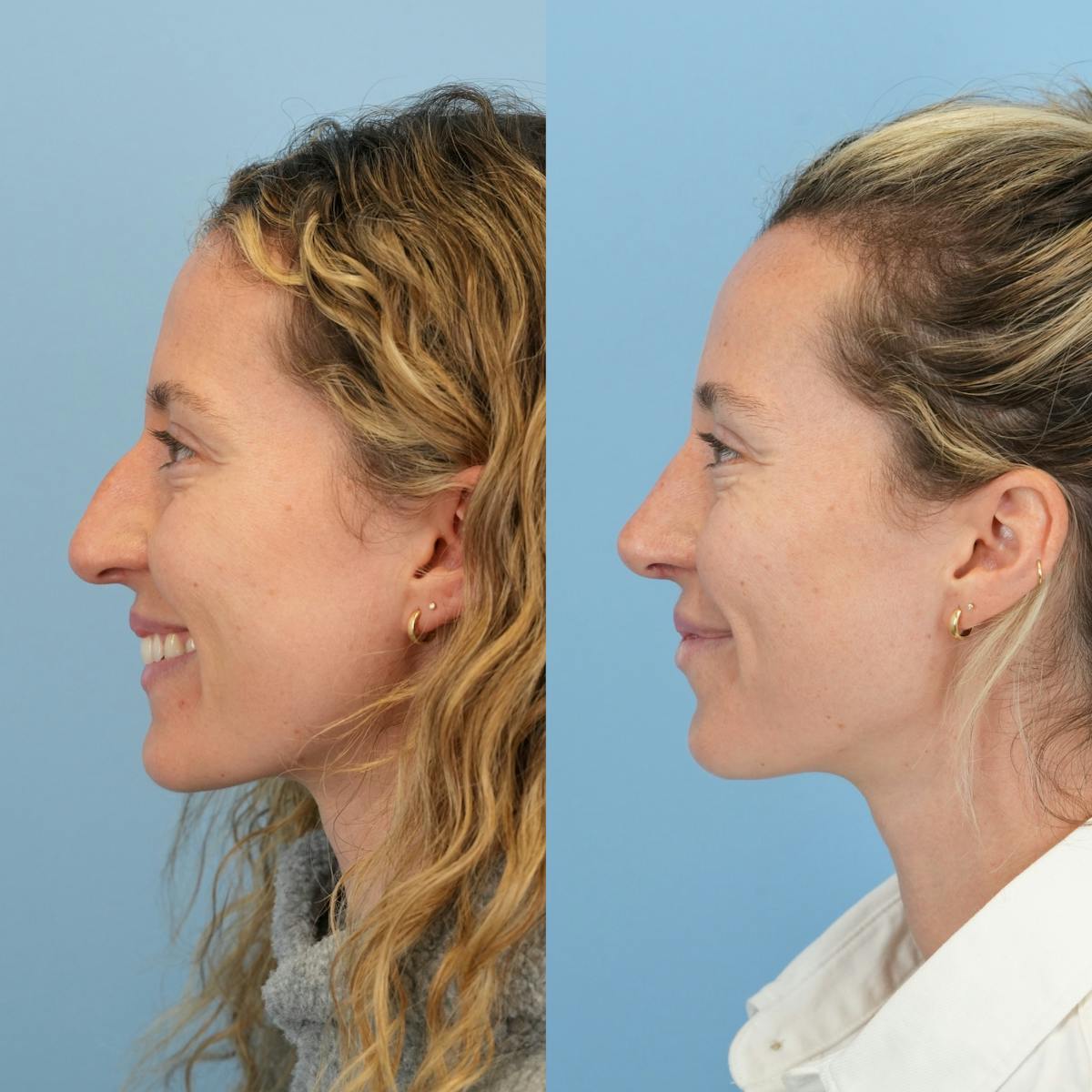 Rhinoplasty Before & After Gallery - Patient 417134 - Image 8