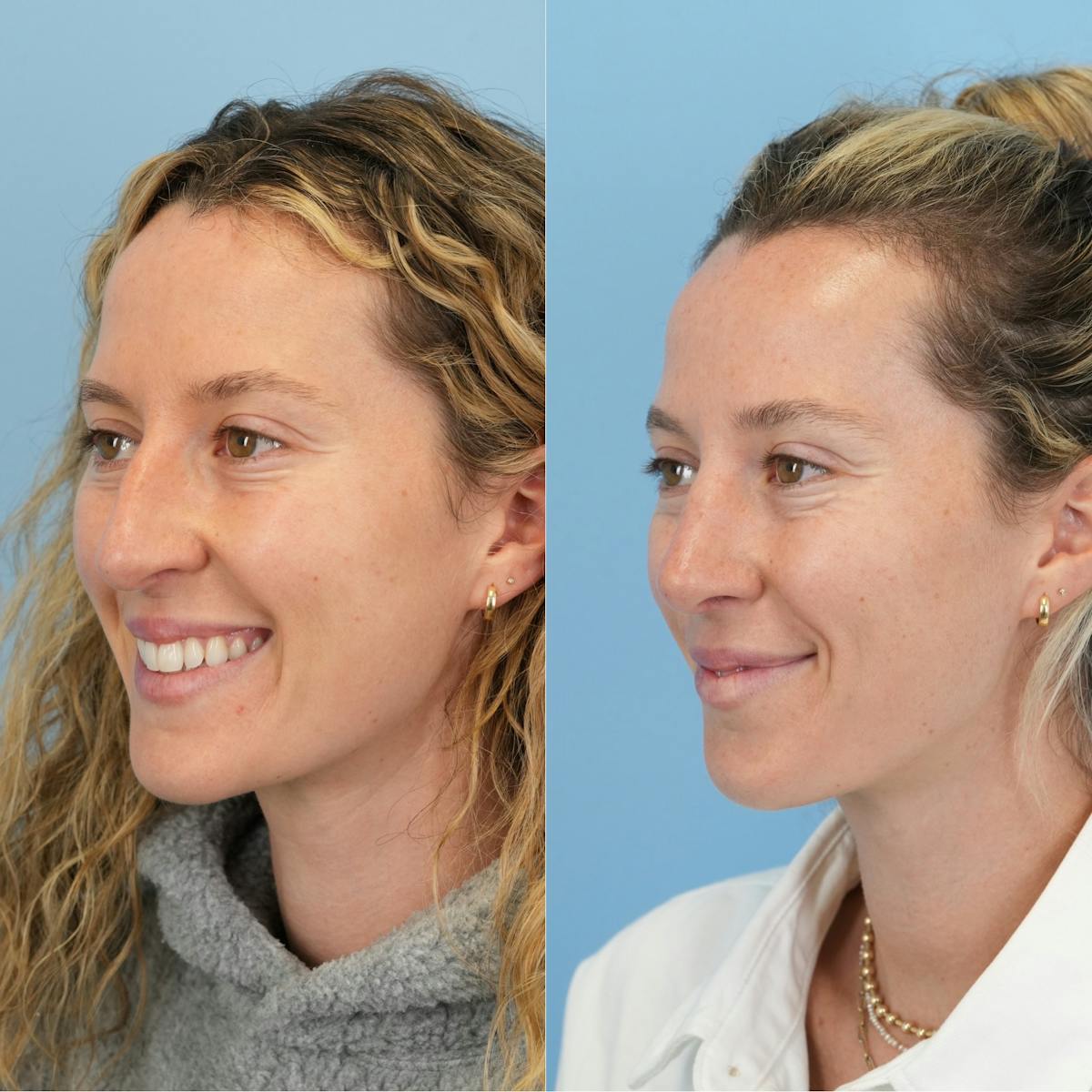 Rhinoplasty Before & After Gallery - Patient 417134 - Image 6