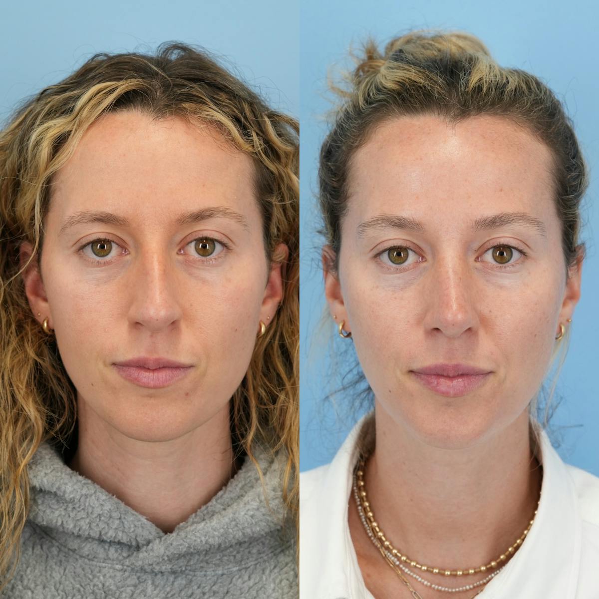 Rhinoplasty Before & After Gallery - Patient 417134 - Image 5