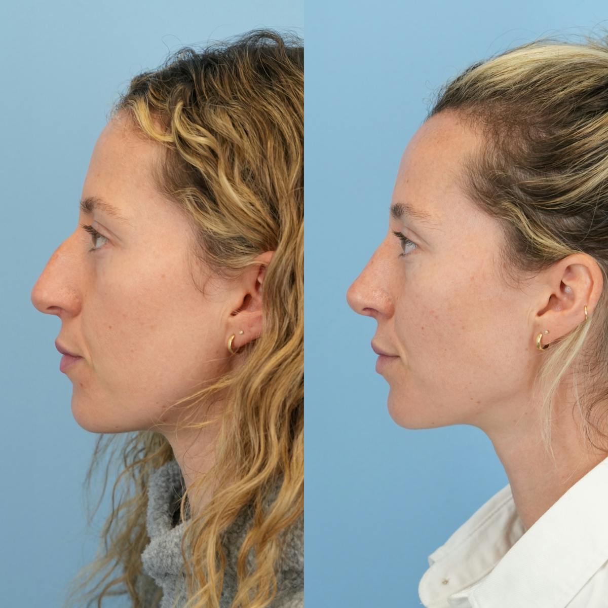 Rhinoplasty Before & After Gallery - Patient 417134 - Image 9