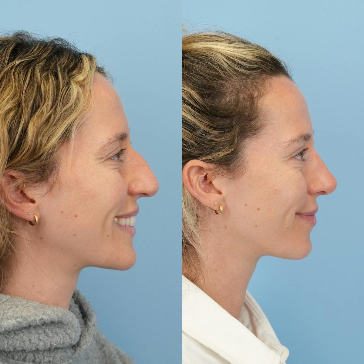 Rhinoplasty Before & After Gallery - Patient 417134 - Image 2