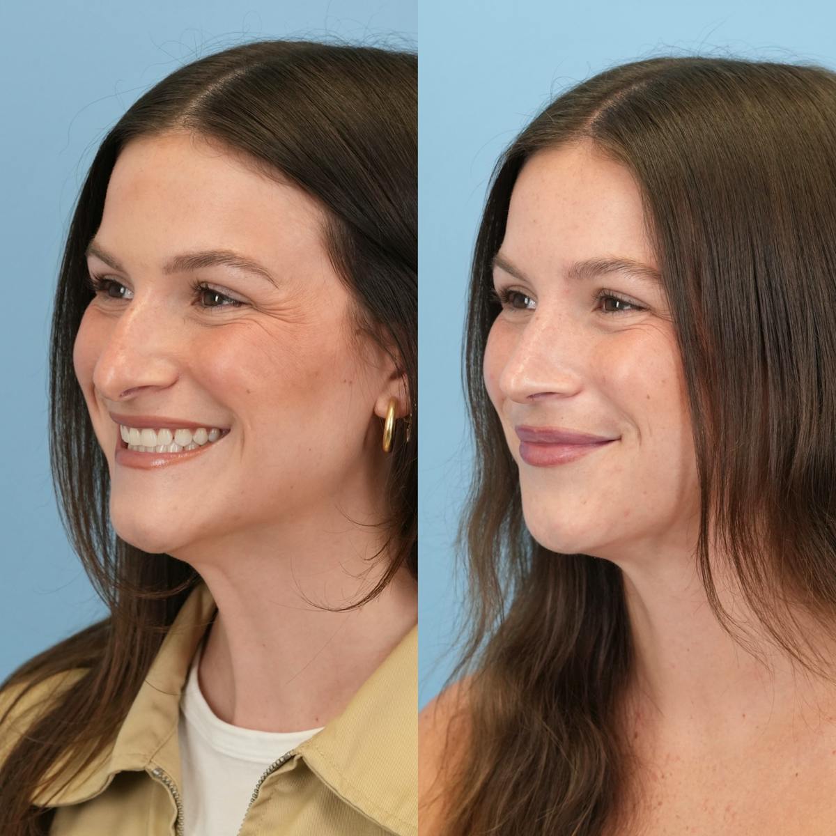 Rhinoplasty Before & After Gallery - Patient 104303 - Image 6