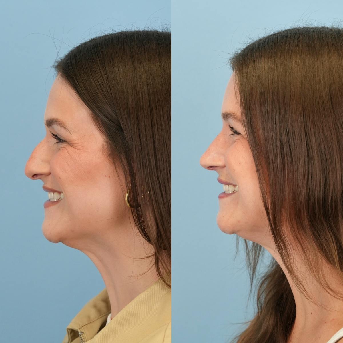 Rhinoplasty Before & After Gallery - Patient 104303 - Image 8