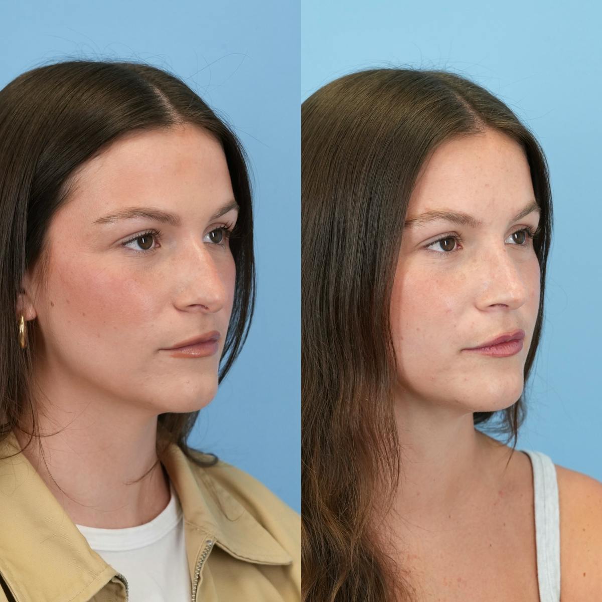 Rhinoplasty Before & After Gallery - Patient 104303 - Image 3