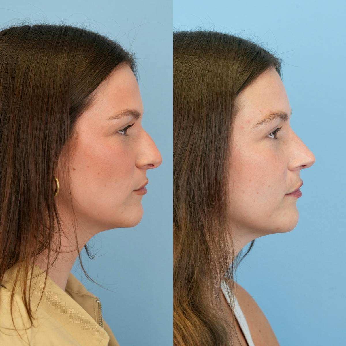 Rhinoplasty Before & After Gallery - Patient 104303 - Image 1