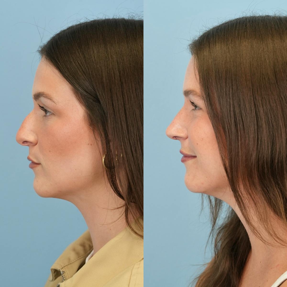 Rhinoplasty Before & After Gallery - Patient 104303 - Image 9
