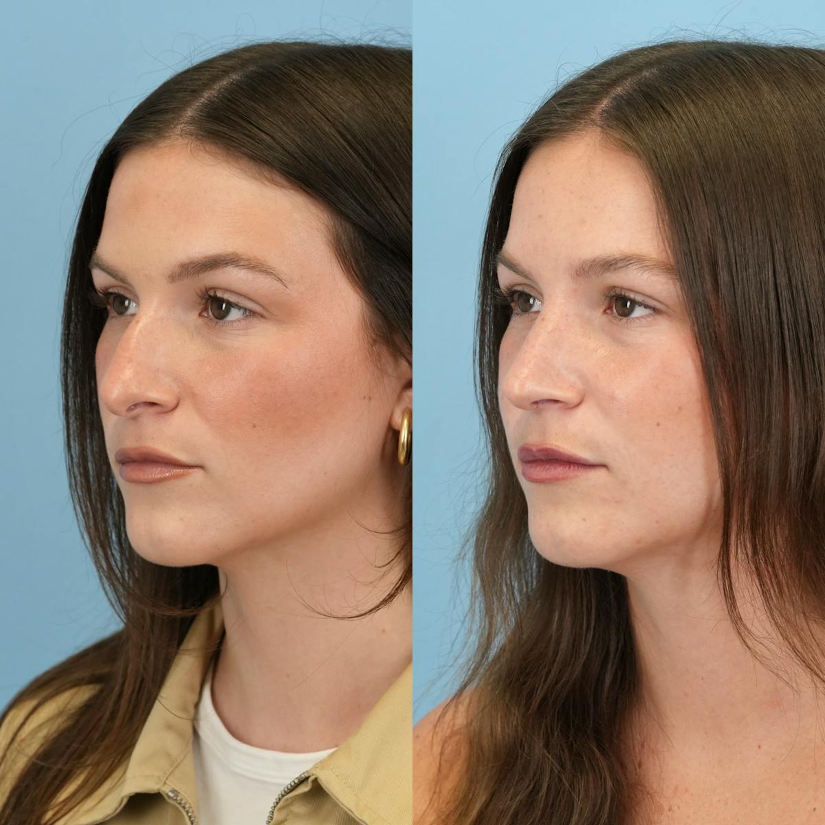 Rhinoplasty Before & After Gallery - Patient 104303 - Image 7