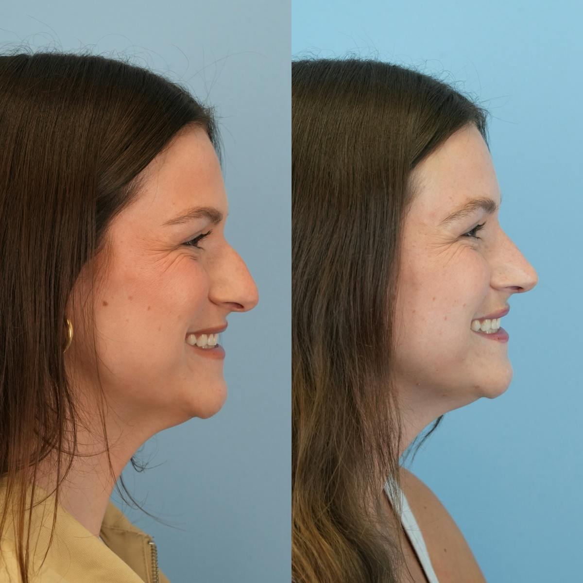 Rhinoplasty Before & After Gallery - Patient 104303 - Image 2