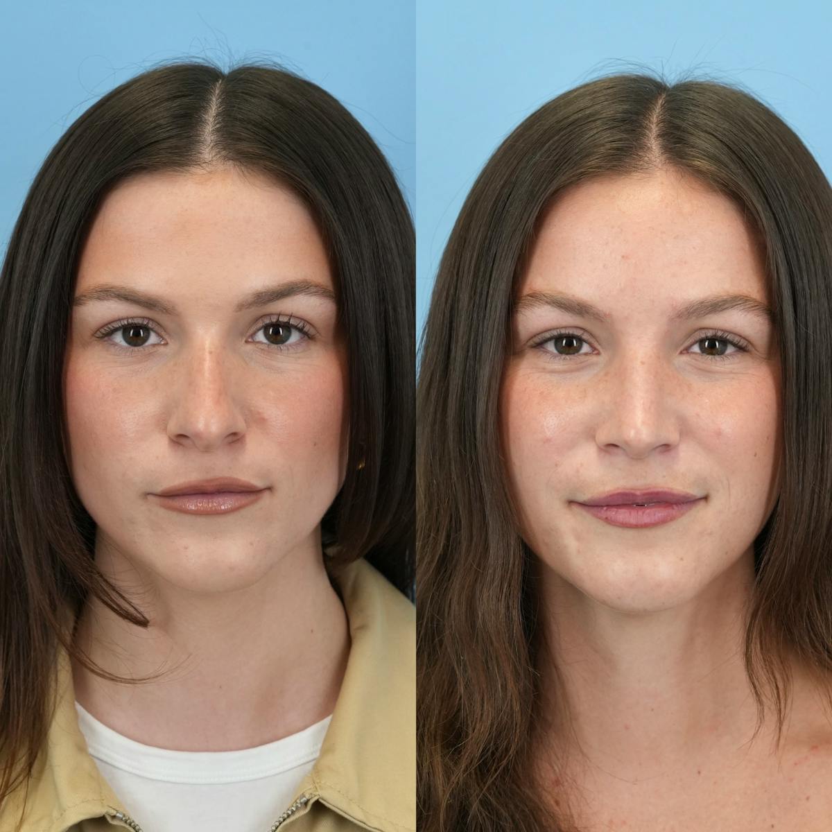 Rhinoplasty Before & After Gallery - Patient 104303 - Image 5