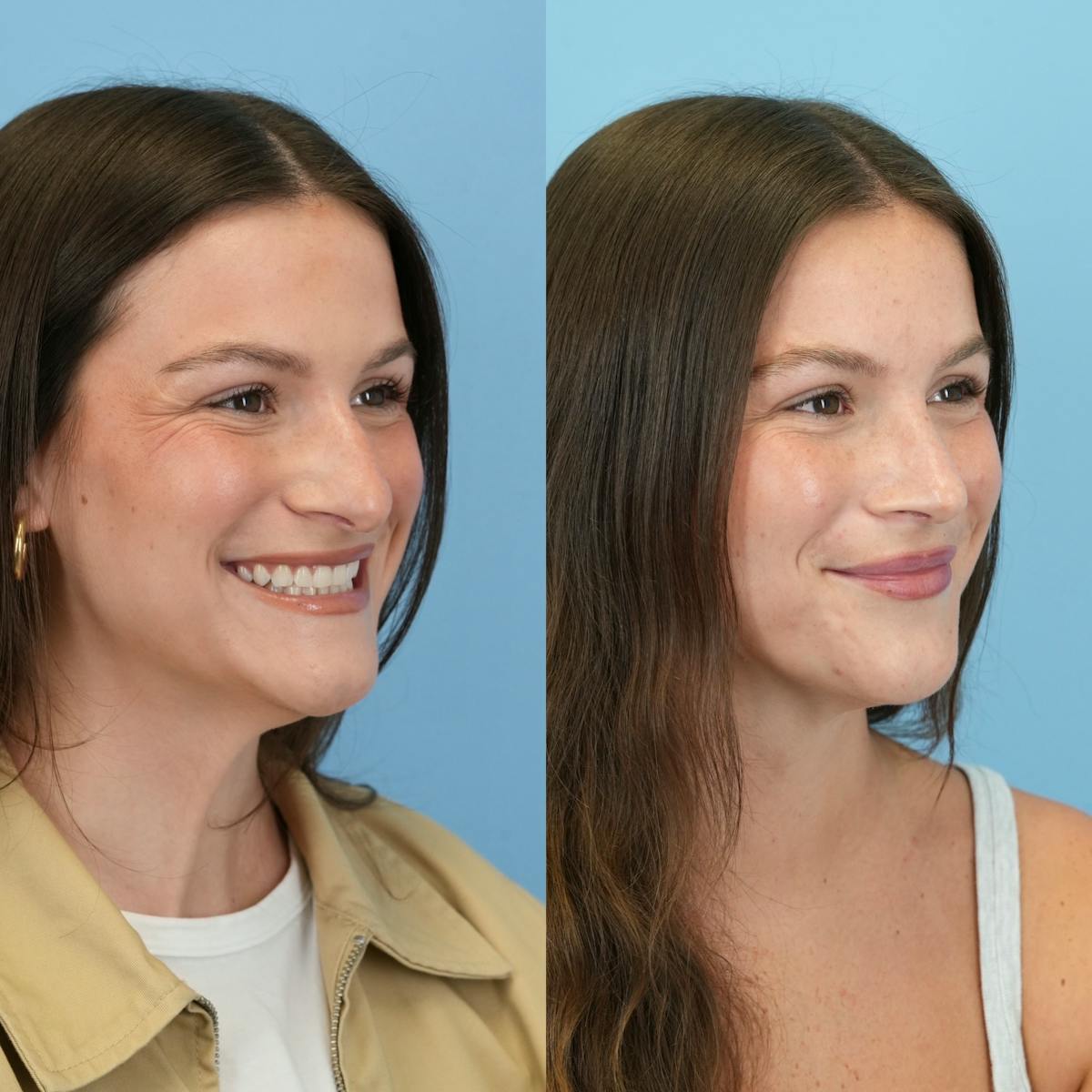 Rhinoplasty Before & After Gallery - Patient 104303 - Image 4