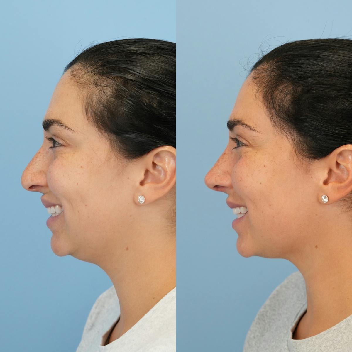 Rhinoplasty Before & After Gallery - Patient 277130 - Image 8