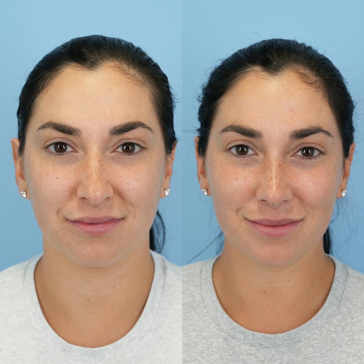 Rhinoplasty Before & After Gallery - Patient 277130 - Image 5