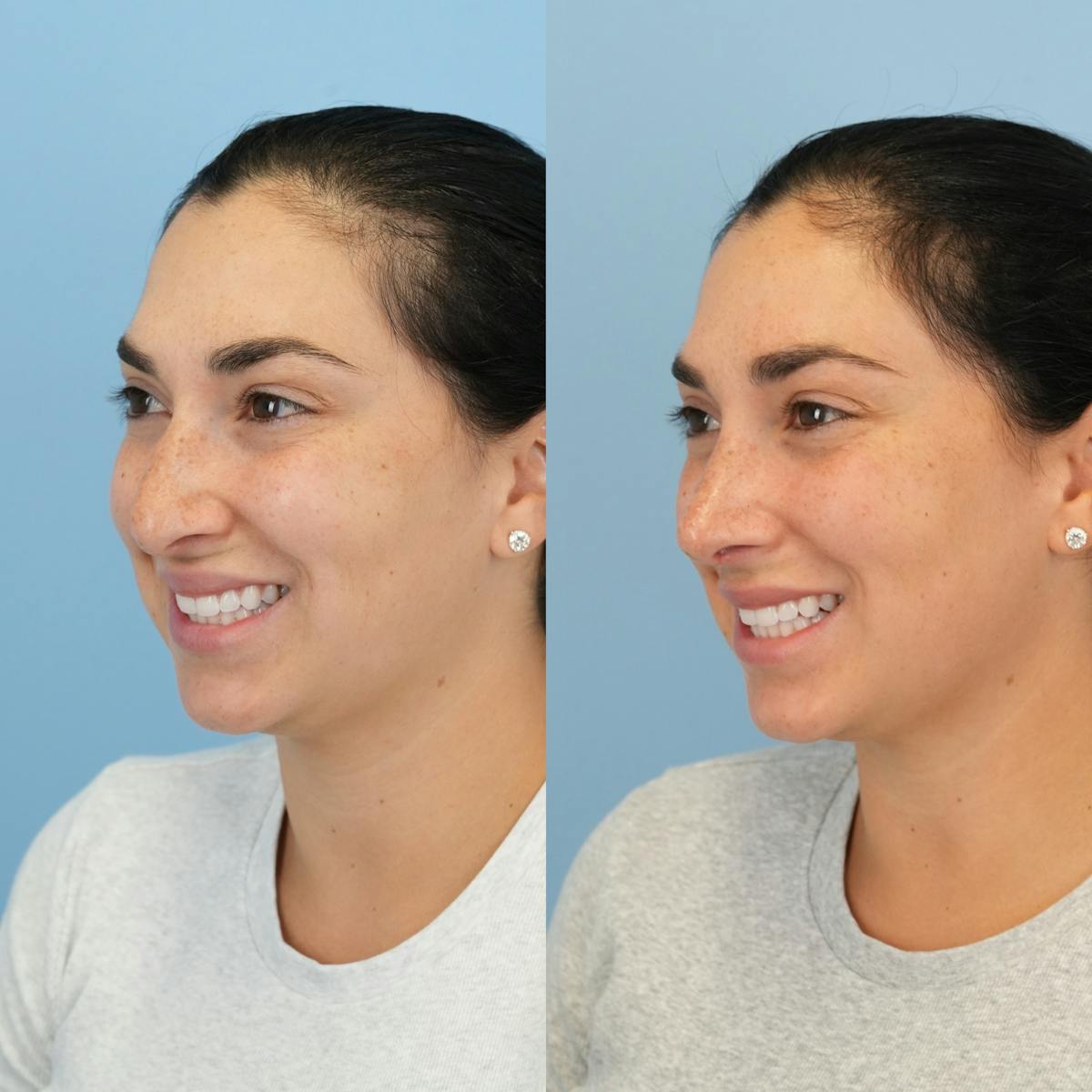 Rhinoplasty Before & After Gallery - Patient 277130 - Image 6