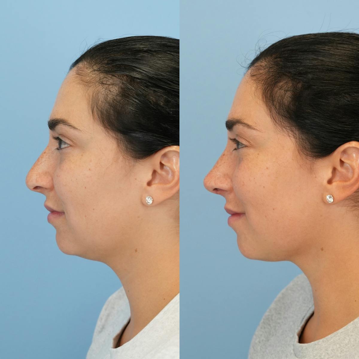 Rhinoplasty Before & After Gallery - Patient 277130 - Image 9