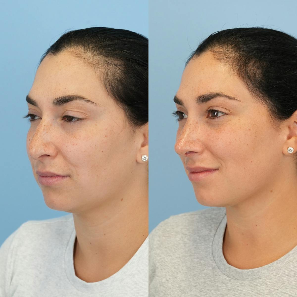 Rhinoplasty Before & After Gallery - Patient 277130 - Image 7