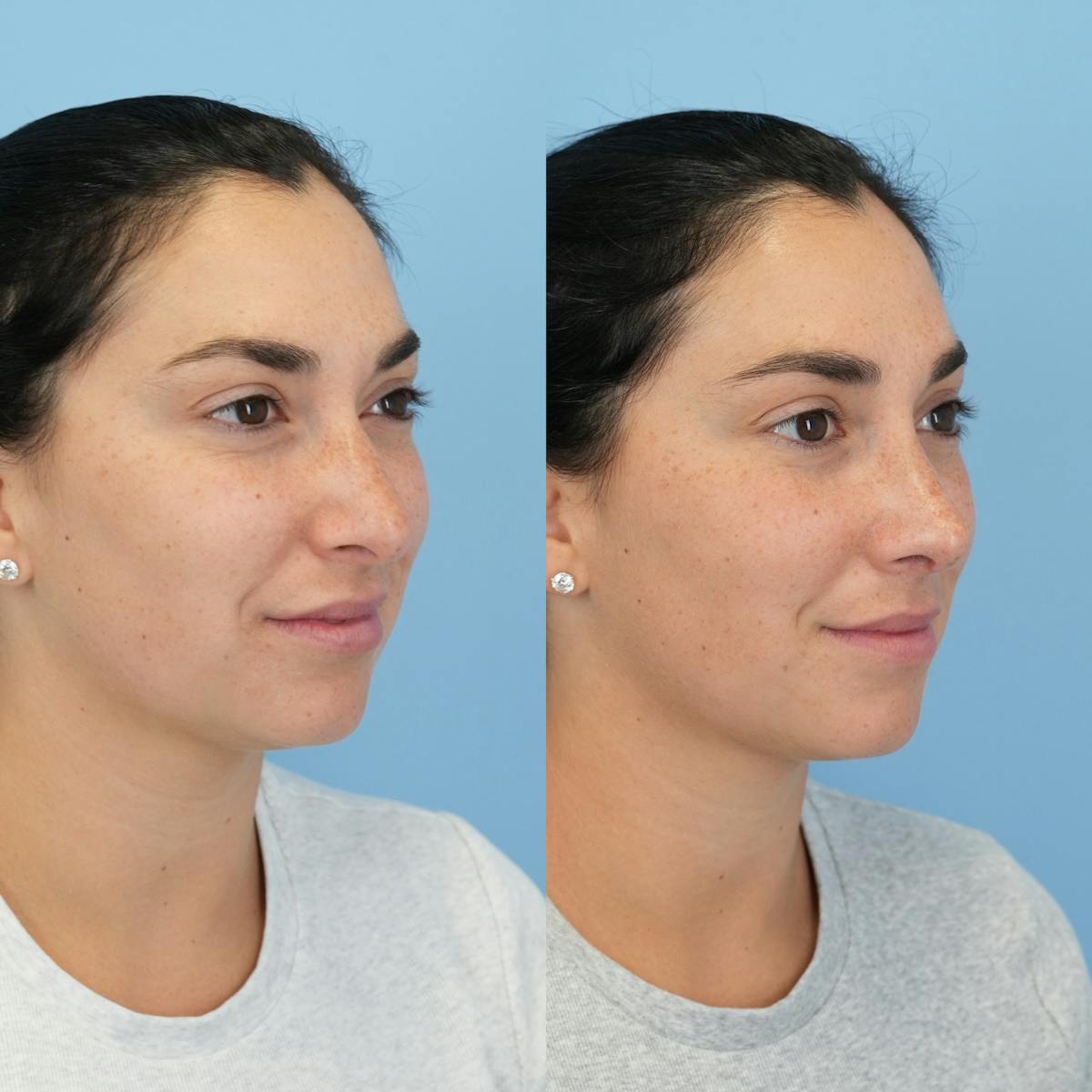 Rhinoplasty Before & After Gallery - Patient 277130 - Image 3