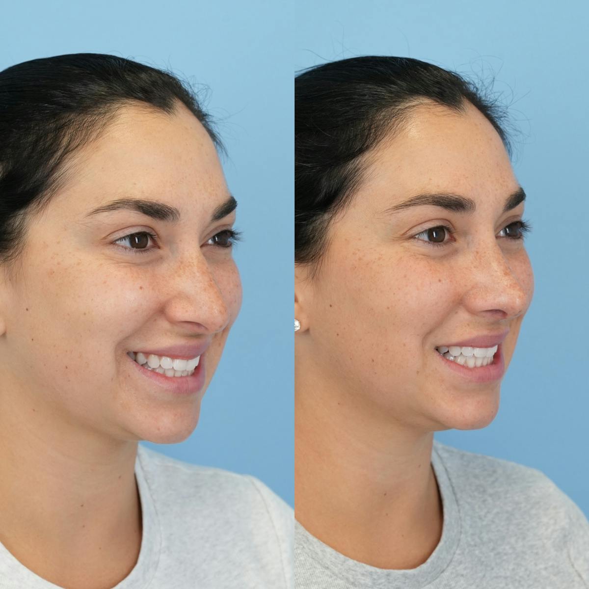 Rhinoplasty Before & After Gallery - Patient 277130 - Image 4
