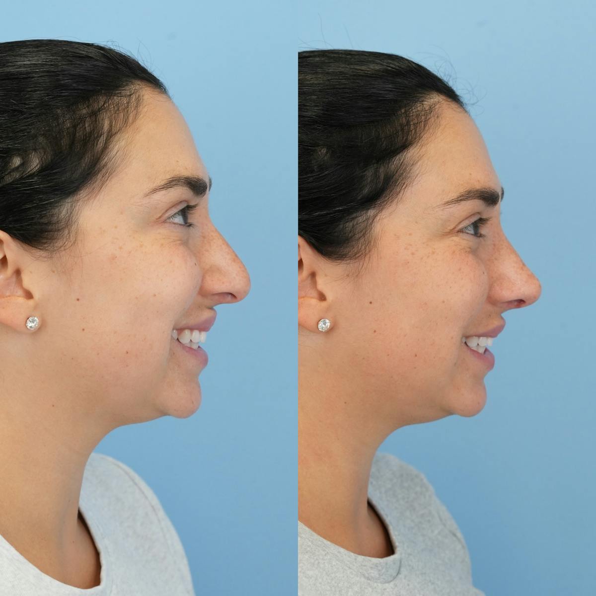Rhinoplasty Before & After Gallery - Patient 277130 - Image 2
