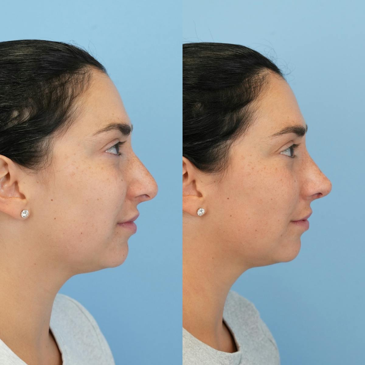 Rhinoplasty Before & After Gallery - Patient 277130 - Image 1