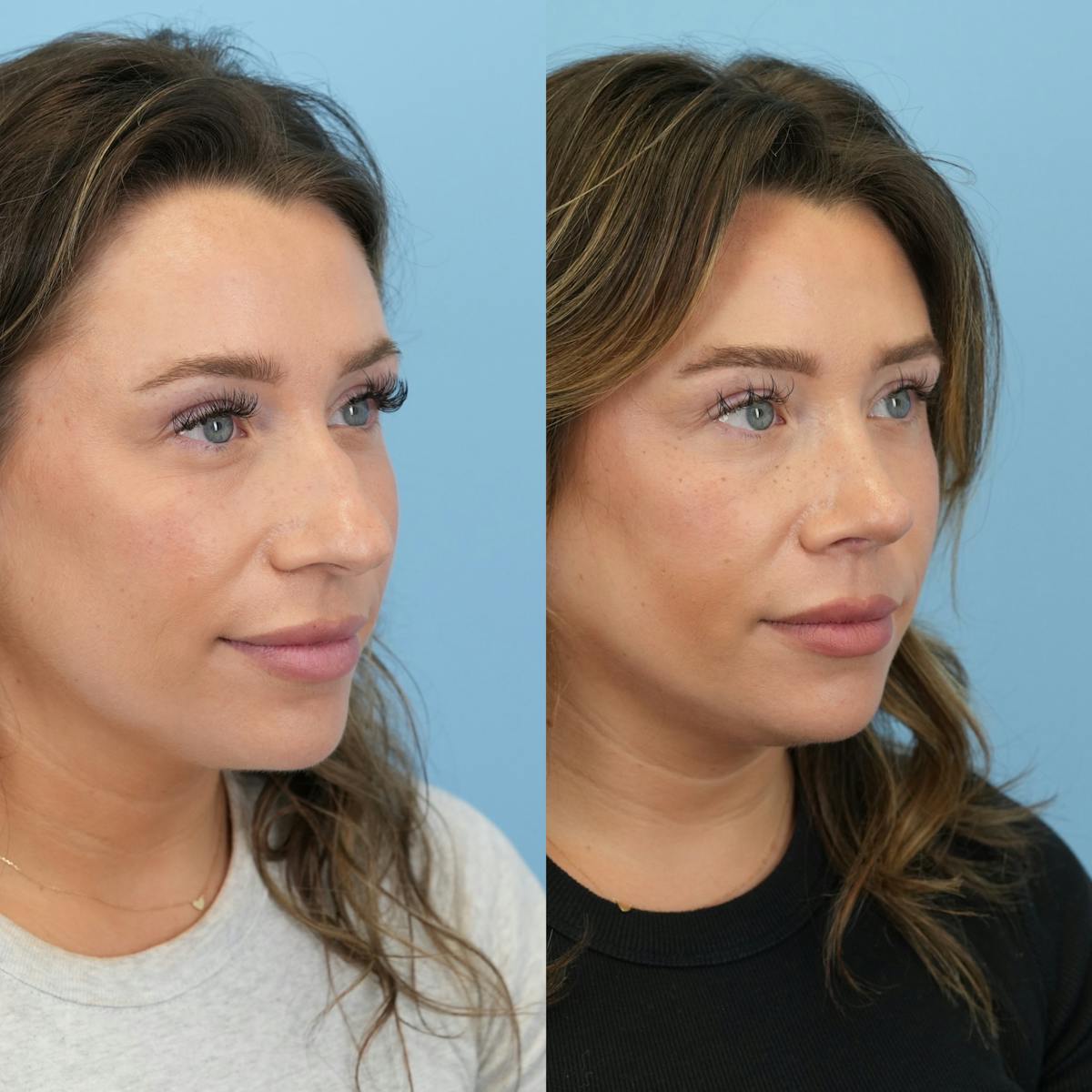 Rhinoplasty Before & After Gallery - Patient 425751 - Image 3