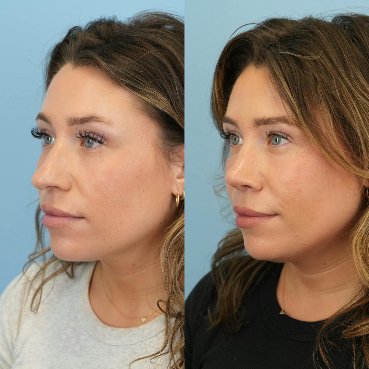 Rhinoplasty Before & After Gallery - Patient 425751 - Image 7